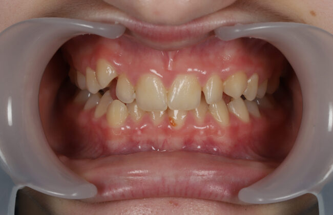 Before (Teeth)