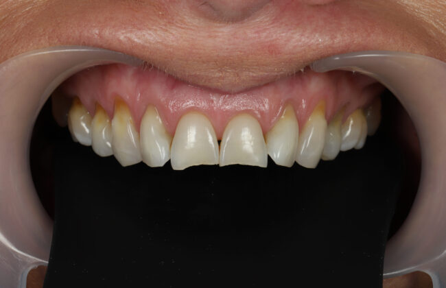 Before (Teeth)