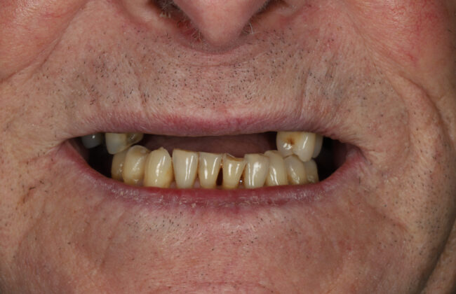 Before (Teeth)