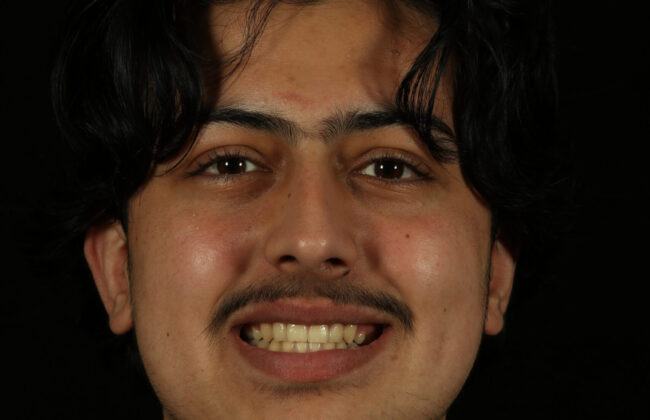 After (Teeth)