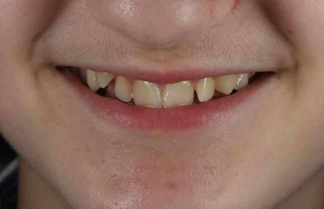 Before (Teeth)