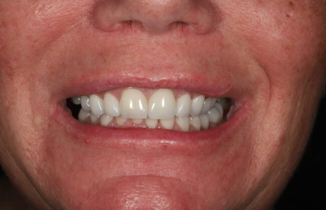 After (Teeth)
