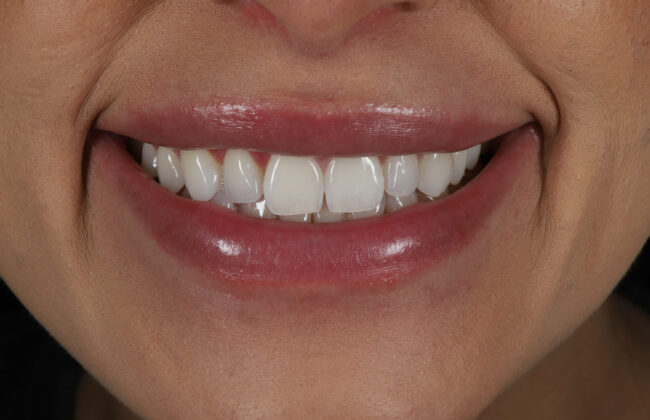 Before (Teeth)