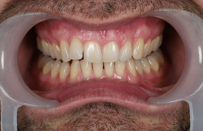 Before (Teeth)