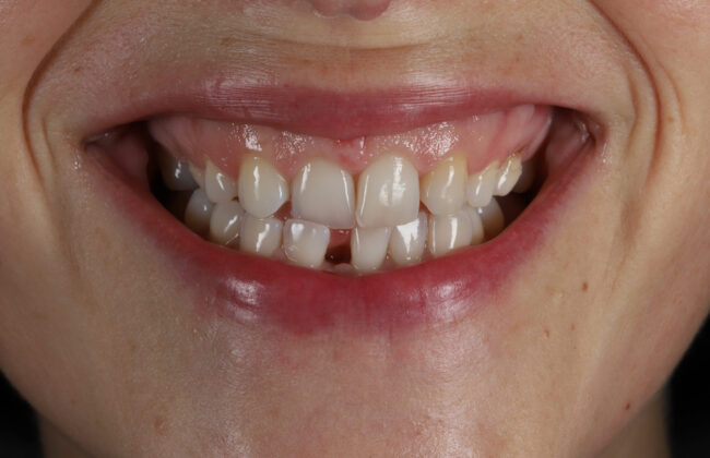 Before (Teeth)
