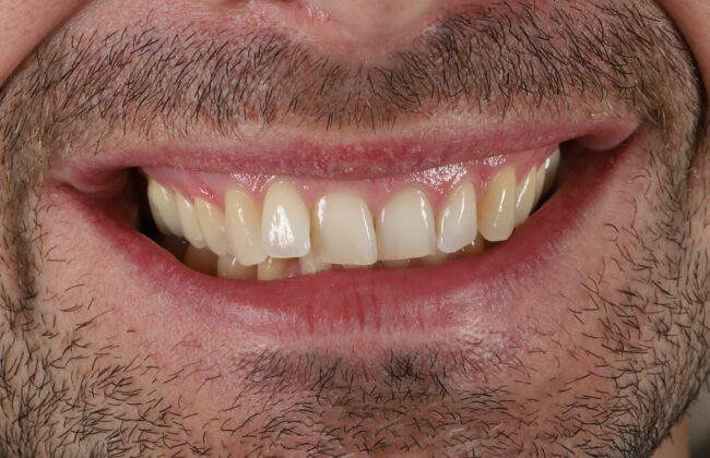 Before (Teeth)