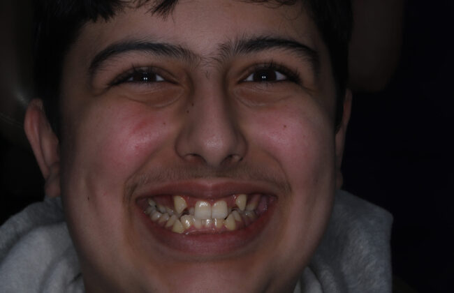 Before (Teeth)