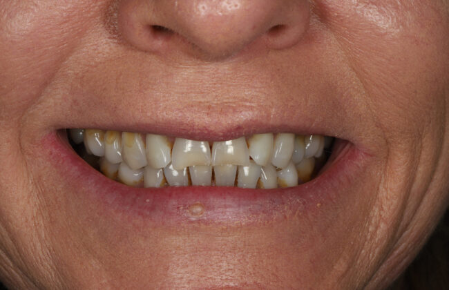 Before (Teeth)