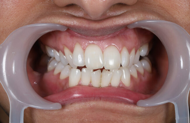 Before (Teeth)