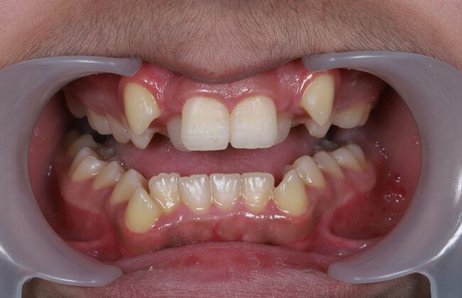 Before (Teeth)