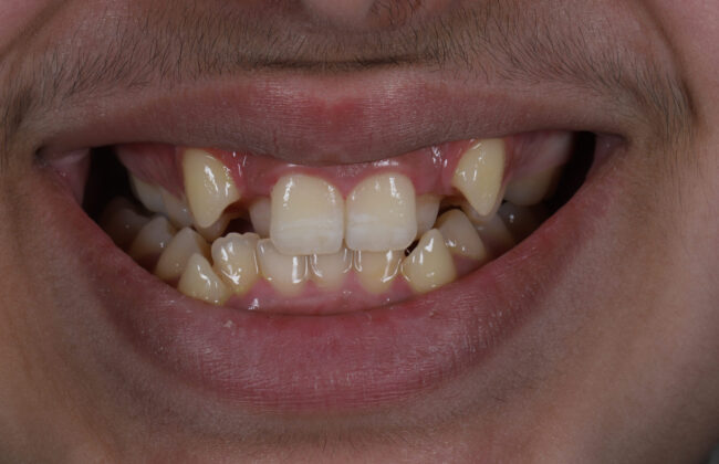 Before (Teeth)