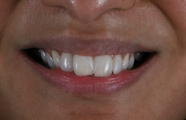 Before (Teeth)