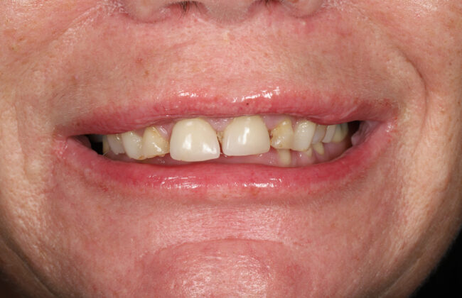 Before (Teeth)