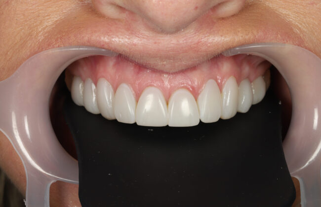 After (Teeth)