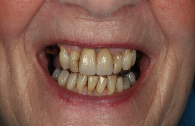 After (Teeth)
