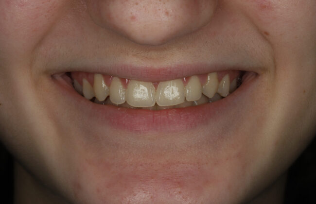 After (Teeth)