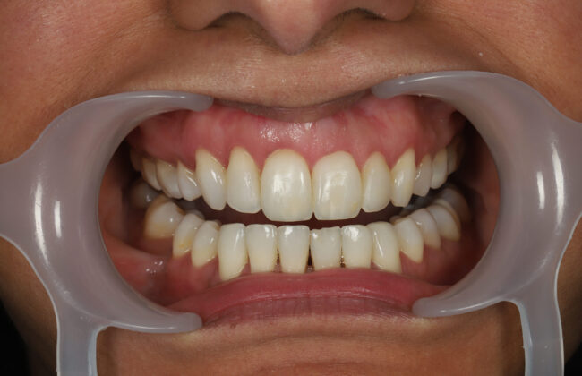 After (Teeth)