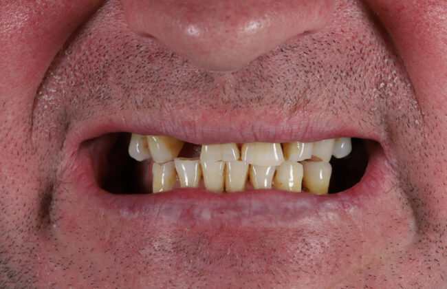Before (Teeth)