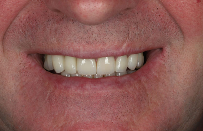 After (Teeth)