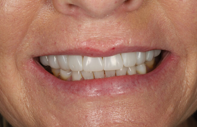 After (Teeth)