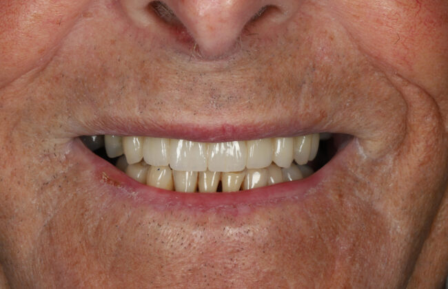 After (Teeth)