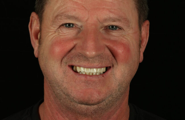 After (Teeth)