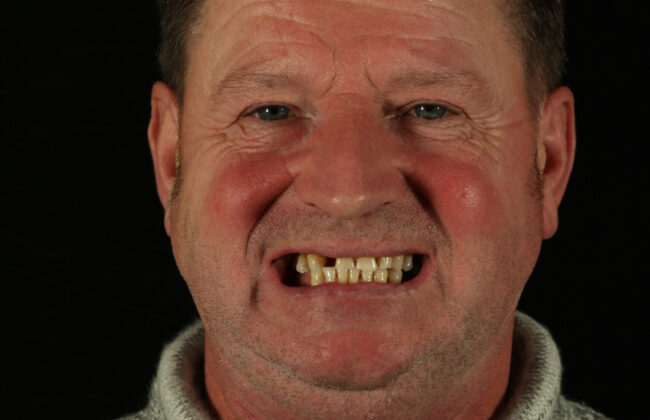 Before (Teeth)