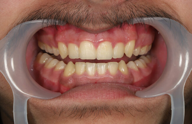 After (Teeth)