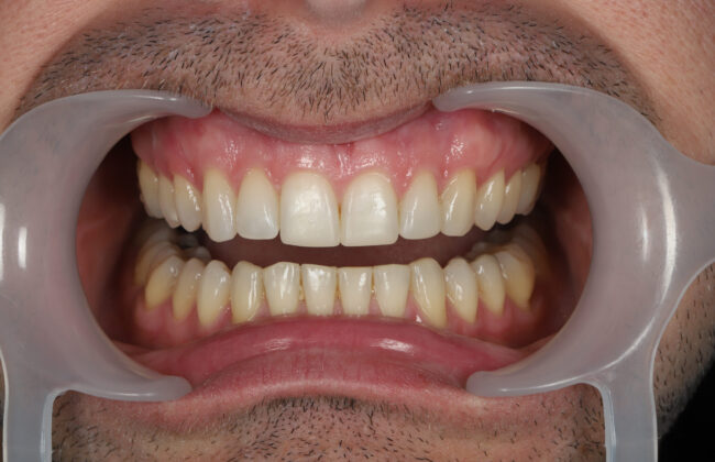 After (Teeth)