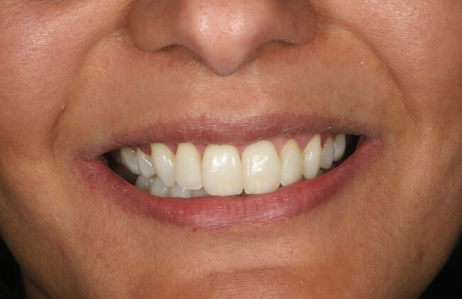 After (Teeth)