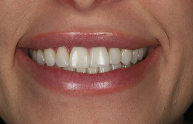 After (Teeth)