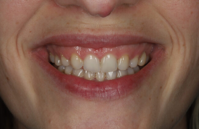 After (Teeth)