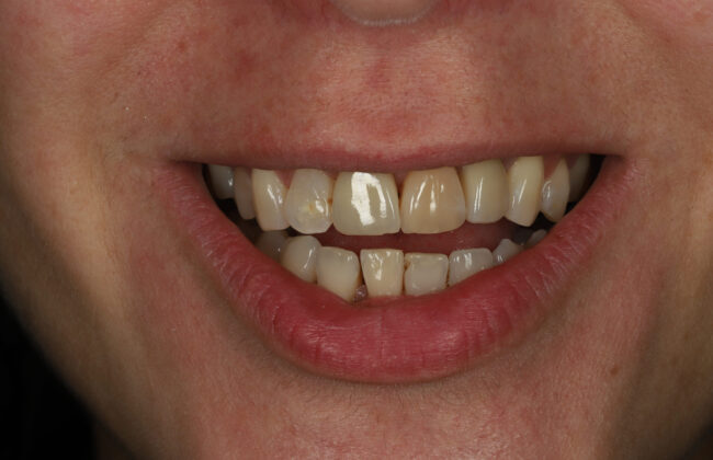 After (Teeth)