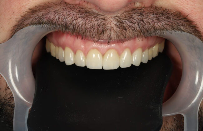 After (Teeth)