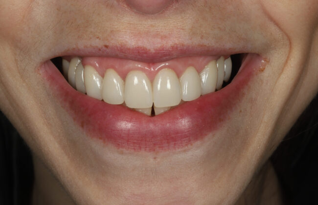 After (Teeth)