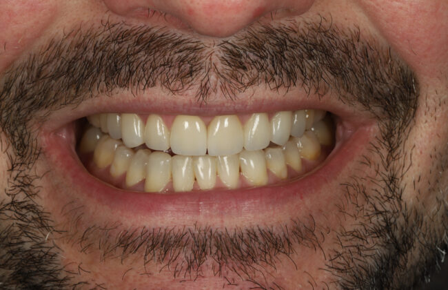After (Teeth)