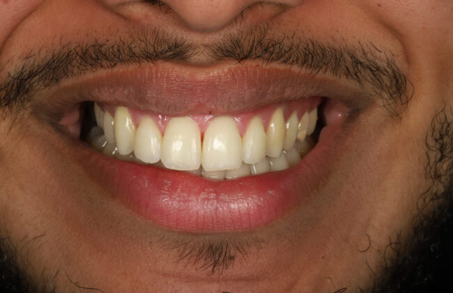 After (Teeth)