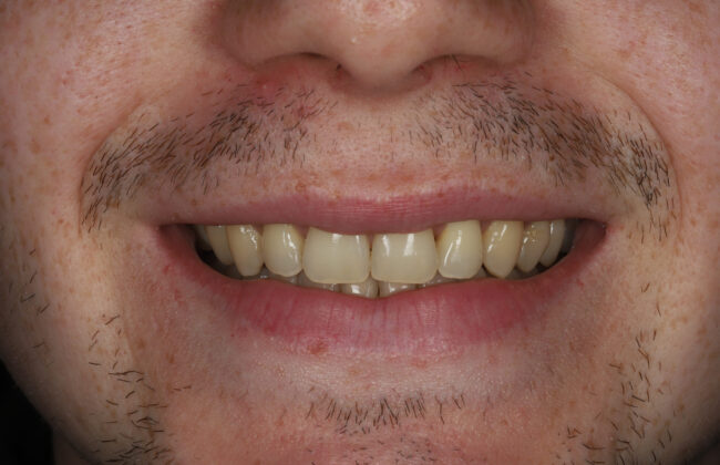 After (Teeth)