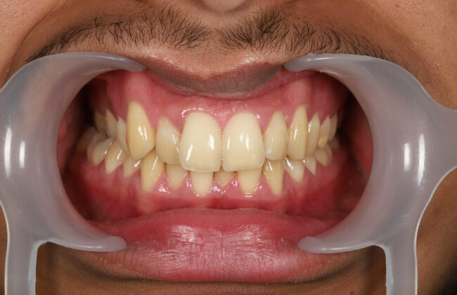 Before (Teeth)