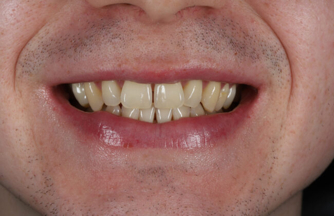 Before (Teeth)