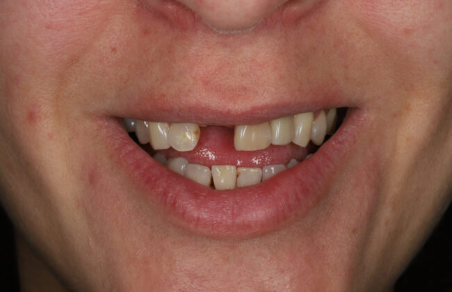 Before (Teeth)