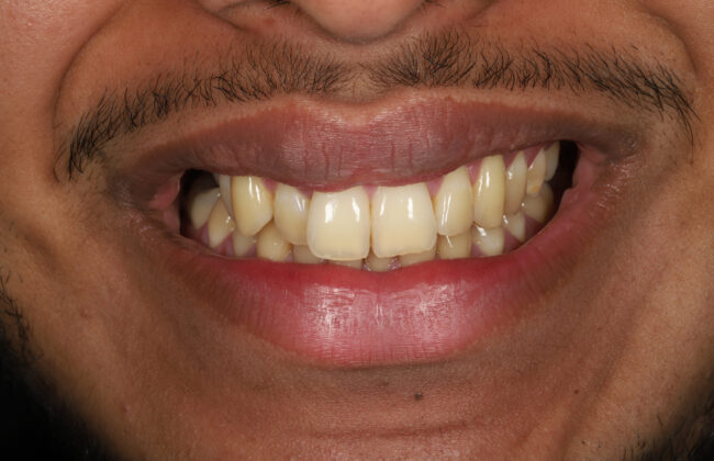 Before (Teeth)