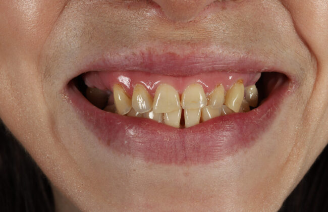 Before (Teeth)