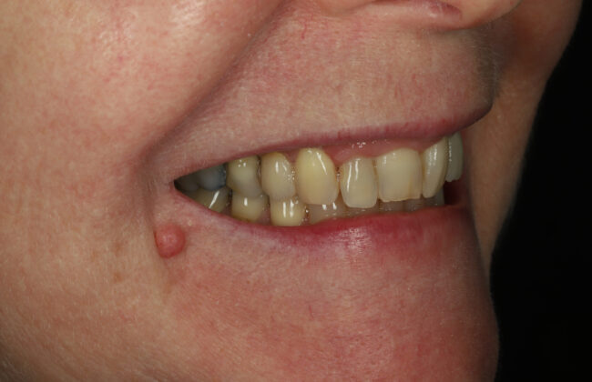 After (Teeth)
