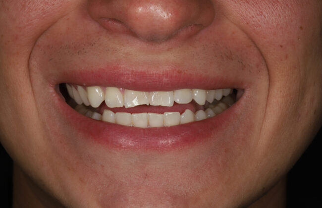 Before (Teeth)