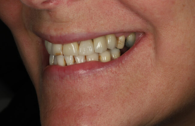 After (Teeth)