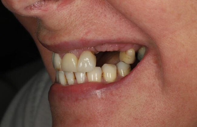 Before (Teeth)