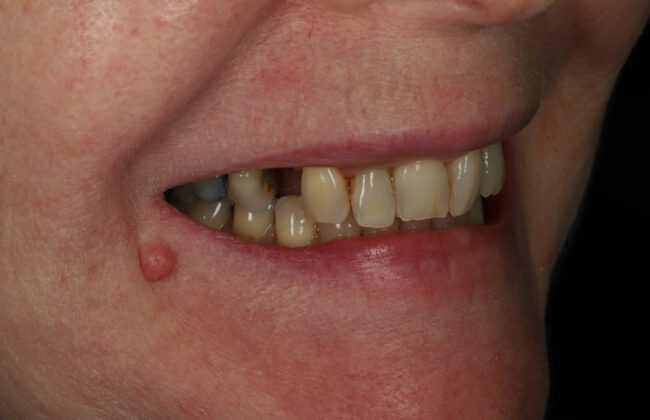 Before (Teeth)
