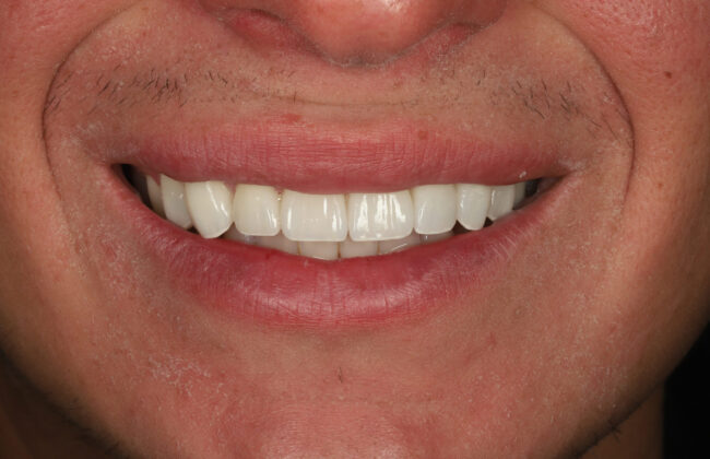 After (Teeth)