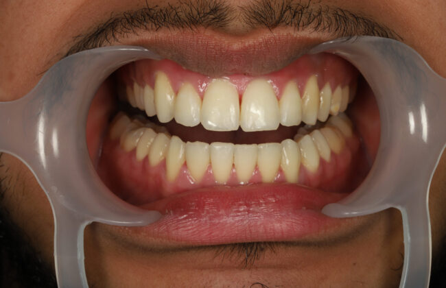 After (Teeth)
